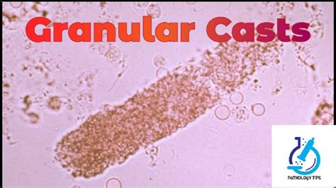 Granular Casts in Urine || Under 40X microscope || - YouTube