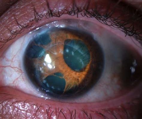 India’s first siRNA drug to treat rare eye disease soon - BioVoiceNews