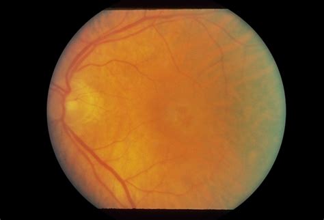 Cystoid Macular Edema (CME) - Retina Image Bank