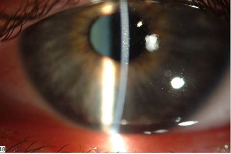 Keratitis - Causes, Symptoms, Diagnosis, Prevention, Treatment