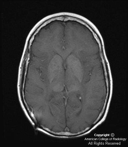 Neuroradiology On the Net: Mineralizing microangiopathy