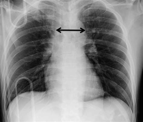 The diagnostic accuracy of the mediastinal width on supine anteroposterior chest radiographs ...