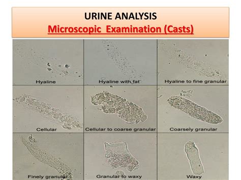 Urinalysis Microscopic Results