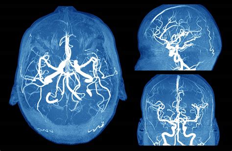 Cerebral Aneurysm Mri