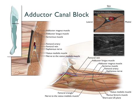 How I Do It: Saphenous Nerve Block