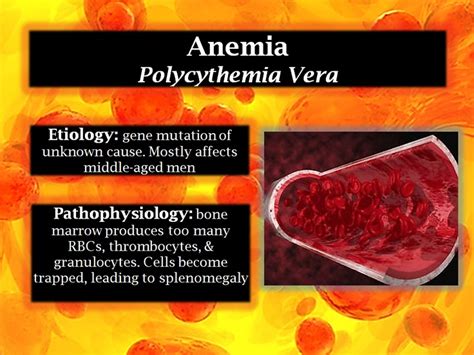 14 best POLYCYTHEMIA VERA images on Pinterest | Blood, Chronic illness and Hematology