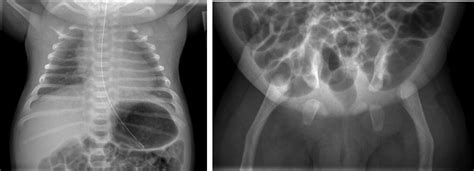 Figure 12. Campomelic dysplasia. bell-shaped thorax, hypoplastic ...