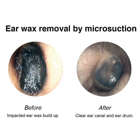 Ear Wax Removal | Podiatry Plus| Ear Care | Corby