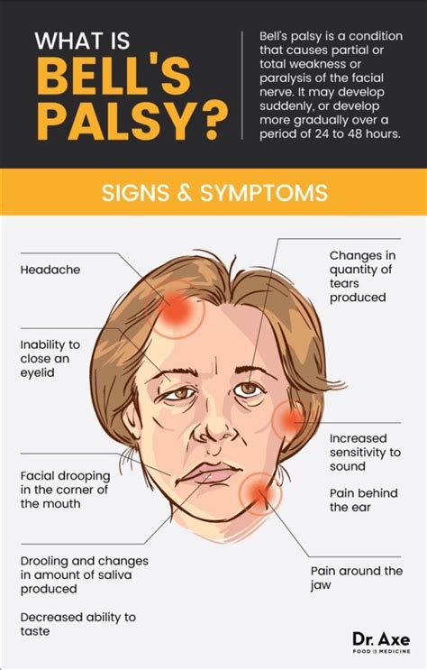 Everything about Bell’s Palsy | News | Dentagama