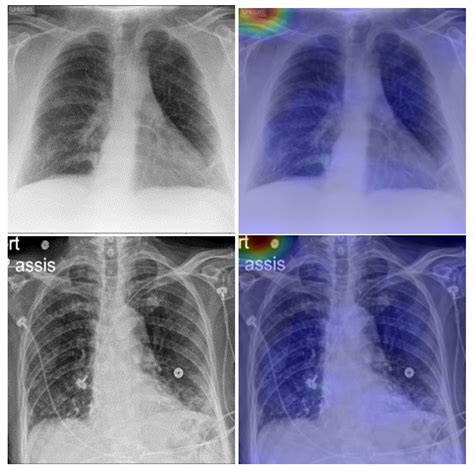 Viruses | Free Full-Text | Explainable COVID-19 Detection Based on Chest X-rays Using an End-to ...