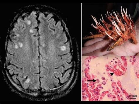 Zombie Fungus Discovered, Over Half Population Already Infected & Don't ...