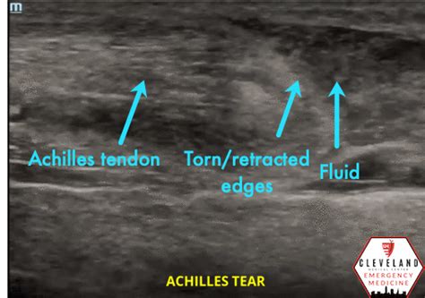 Intern Ultrasound of the Month: Achilles Tendon Rupture — University Hospitals Emergency ...