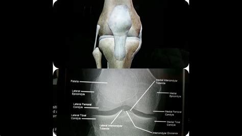 knee x ray anatomy