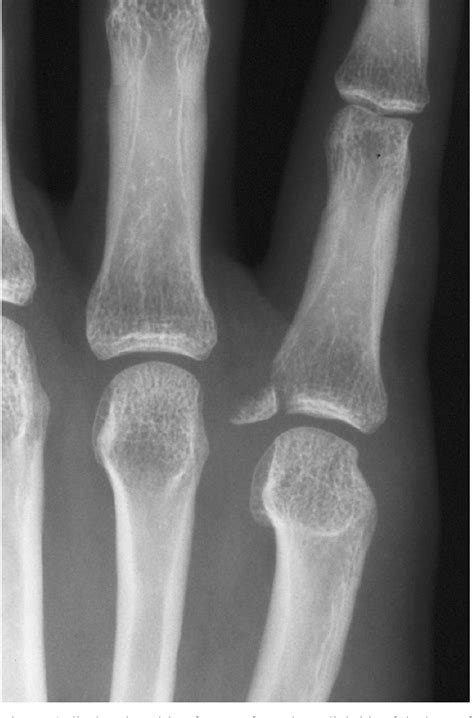 Figure 1 from Avulsion Fractures from the Base of the Proximal Phalanges of the Fingers ...