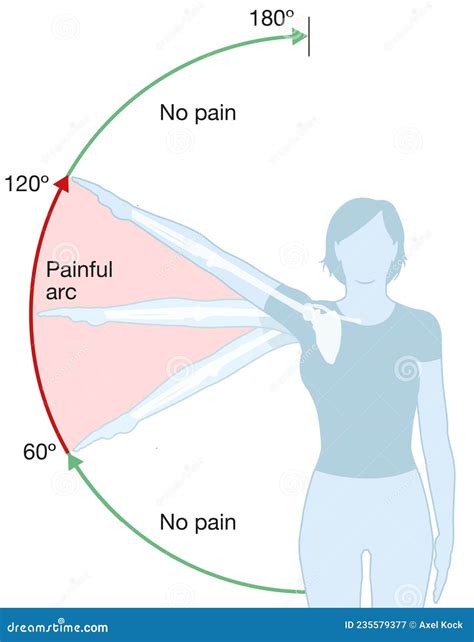 Shoulder Impingement Syndrome. Painful Abduction Stock Photography | CartoonDealer.com #127459328