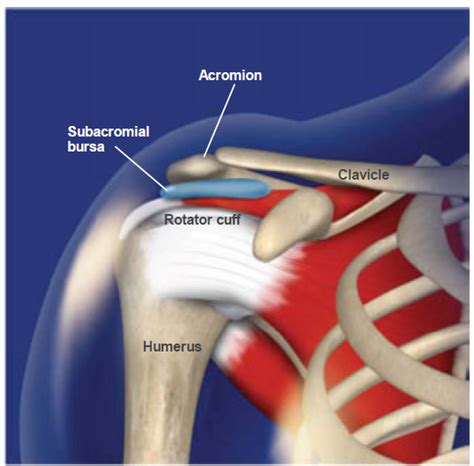 Subacromial Bursitis