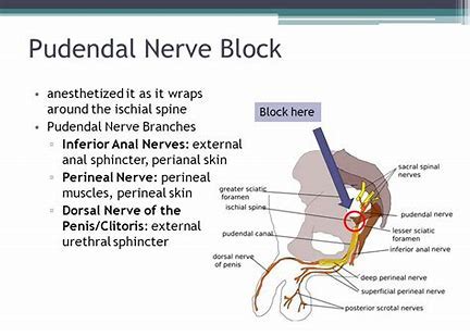 Pudendal Nerve Block - Amara Pain & Spine Management