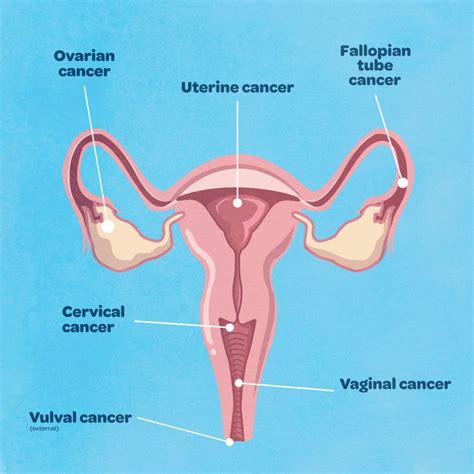 What is gynaecological cancer and what are the symptoms? | Queensland ...