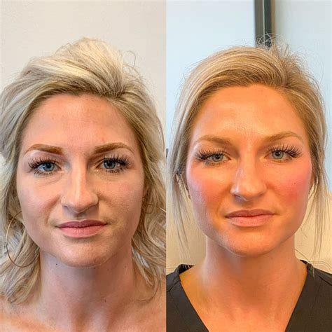 How Cheek Filler Makes You Look Younger - Boss Gal Beauty Bar