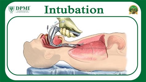 Intubation: What is Intubation? What conditions require Intubation? Types of Intubation - YouTube