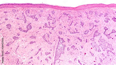 Morpheaform Basal Cell Carcinoma Histology