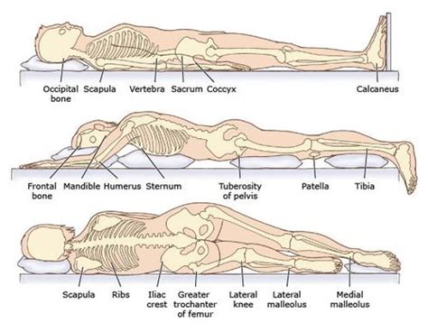 Medical Complications in Spinal Cord Injury - Physiopedia