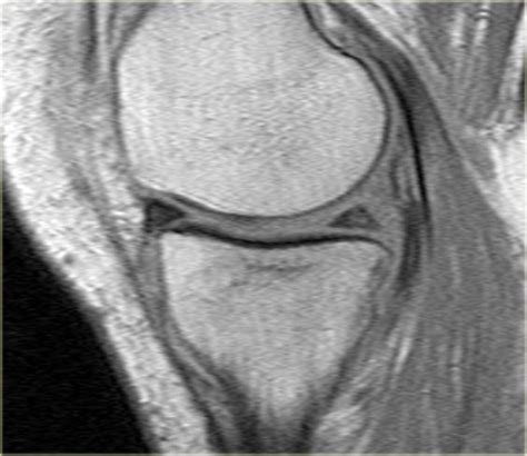 Meniscus Sign X Ray