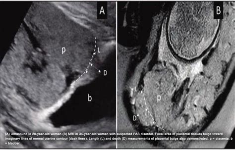 Ultrasound, MRI may help in diagnosis of placenta accreta spectrum ...