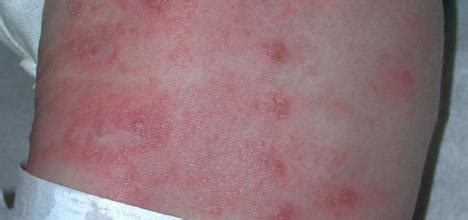 Scabies Rash