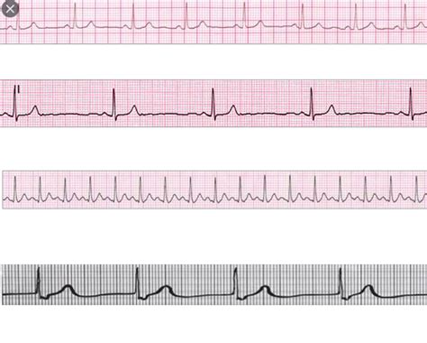 ECG Abnormalities Diagram | Quizlet