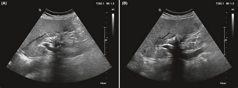 Migration of Hem‐o‐lok clip into the common hepatic duct after laparoscopic bile duct ...