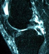 Multiple Knee Ligament Injury | UConn Musculoskeletal Institute