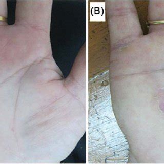 (A) Palmar warts before treatment. (B) Complete resolution after ...