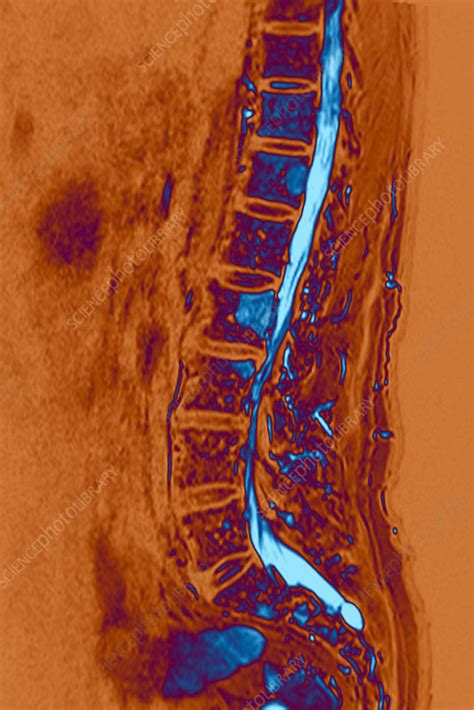 Multiple myeloma of the spine, MRI - Stock Image - C023/4523 - Science Photo Library