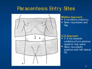 PARACENTESIS COURSE – Hospital Procedures Consultants