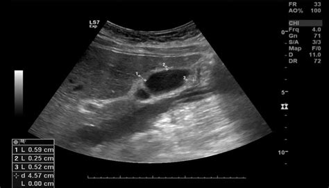 Abdominal ultrasound, on day 5, showing upper normal gallbladder wall... | Download Scientific ...