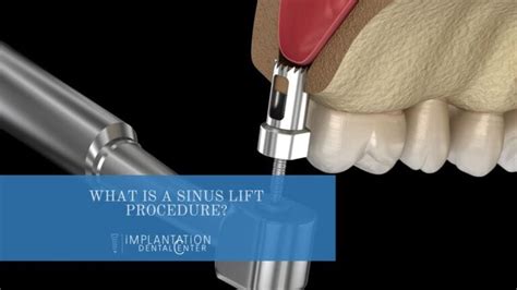 What is a sinus lift procedure? · Implantation Dental Center