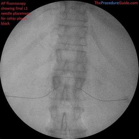 Fluoroscopic Guided Celiac Plexus/Splanchnic Nerve Block - Technique and Overview - The ...