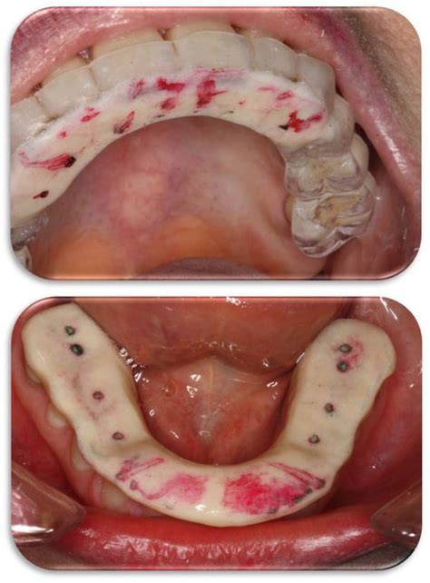 Bite Splints & Nightguards - Kevin D. Huff, DDS, LLC - General Dentist & Orofacial Pain ...