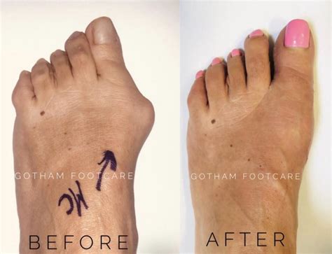 Considering Bunion Surgery: Gotham Footcare: Podiatrists