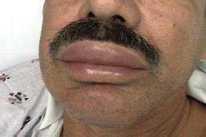 Las ronchas (Urticaria) y angioedema | Hives & Angioedema