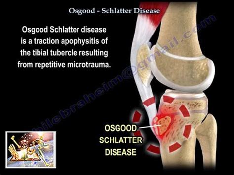 Osgood Schlatter Disease - Everything You Need To Know - Dr. Nabil ...