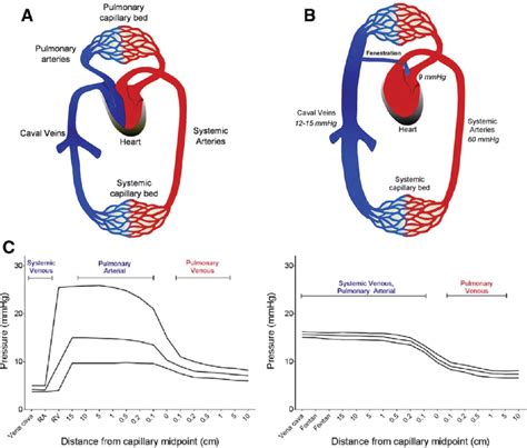 Figure 1 from The pathophysiology and complications of Fontan ...