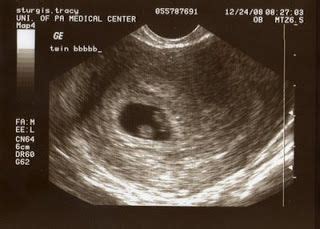 Twin B at 7 weeks: An Exciting Ultrasound Picture