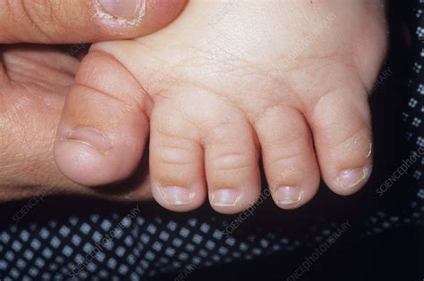 Webbed toes - Stock Image - M350/0292 - Science Photo Library