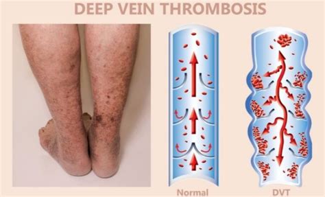 The Top 3 Warning Signs of DVT (Deep Vein Thrombosis) - VISP