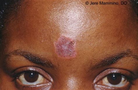 Discoid Lupus Erythematosus - American Osteopathic College of Dermatology (AOCD)