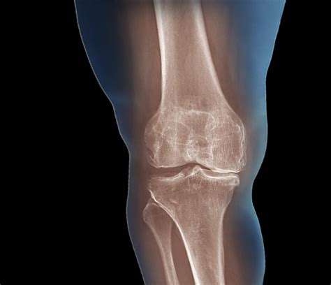 Viscosupplementation for Knee Osteoarthritis - Rheumatology Advisor