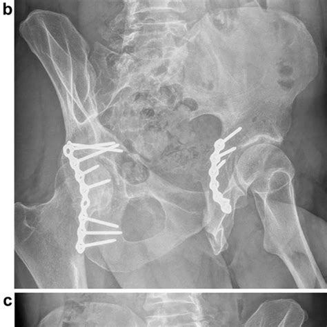 Anteroposterior pelvis radiograph (a) and posterior (b) and oblique (c)... | Download Scientific ...