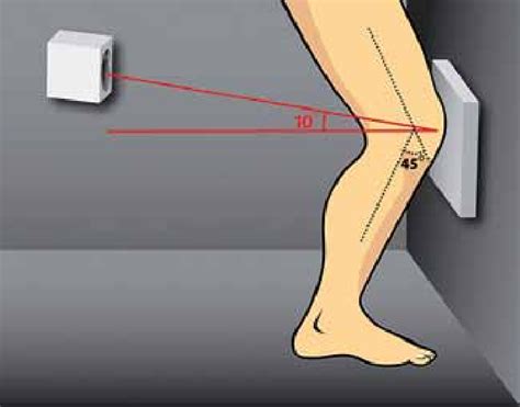 Radiographic method to obtain the Rosenberg View. | Download Scientific Diagram